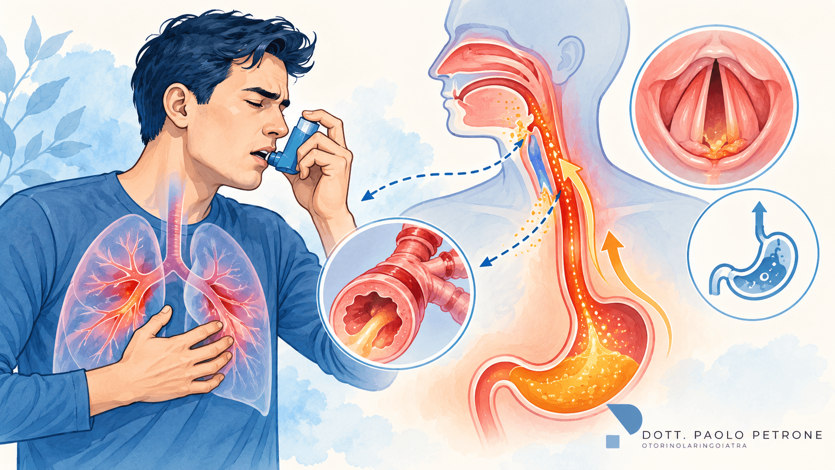 Asma, reflusso gastroesofageo e reflusso laringofaringeo: c’è una connessione? Il punto di vista dell’otorinolaringoiatra
