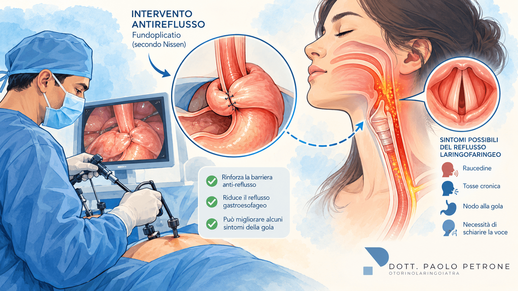 Intervento chirurgico e reflusso gastroesofageo: aiuta a migliorare anche il reflusso laringofaringeo? L’opinione dell’otorinolaringoiatria